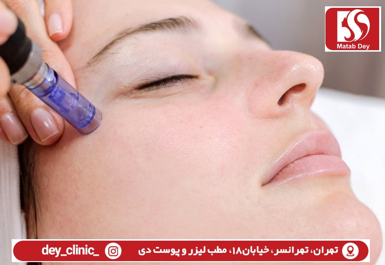 میکرونیدلینگ چیست؟ +مزایا،عوارض،ماندگاری و کاربرد 1 میکرونیدلینگ | مطب لیزر و پوست دی