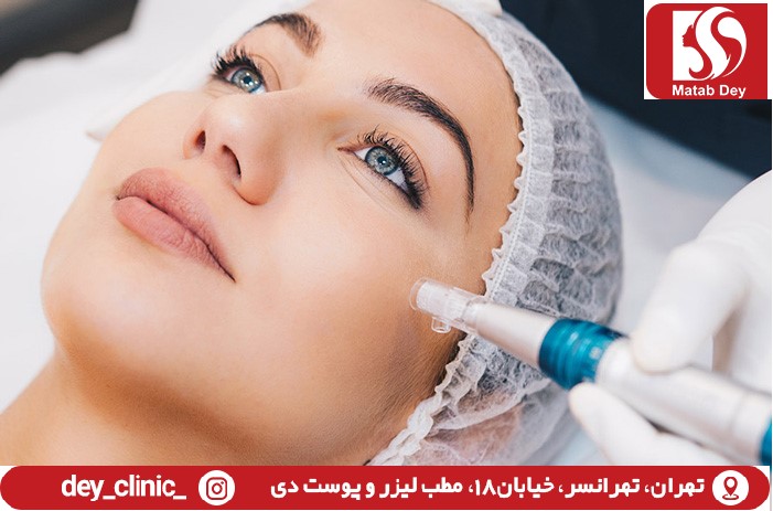 میکرونیدلینگ در تهرانسر | مطب لیزر و پوست دی