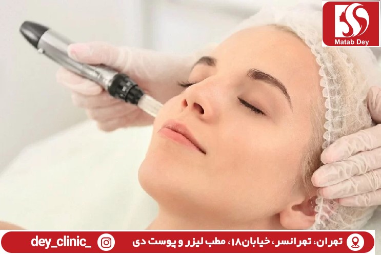 میکرونیدلینگ در تهرانسر | توصیه های مراقبتی | مطب لیزر و پوست دی