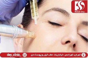 مزونیدلینگ چیست+ کاربرد+مراقبت قبل و بعد +تهرانسر