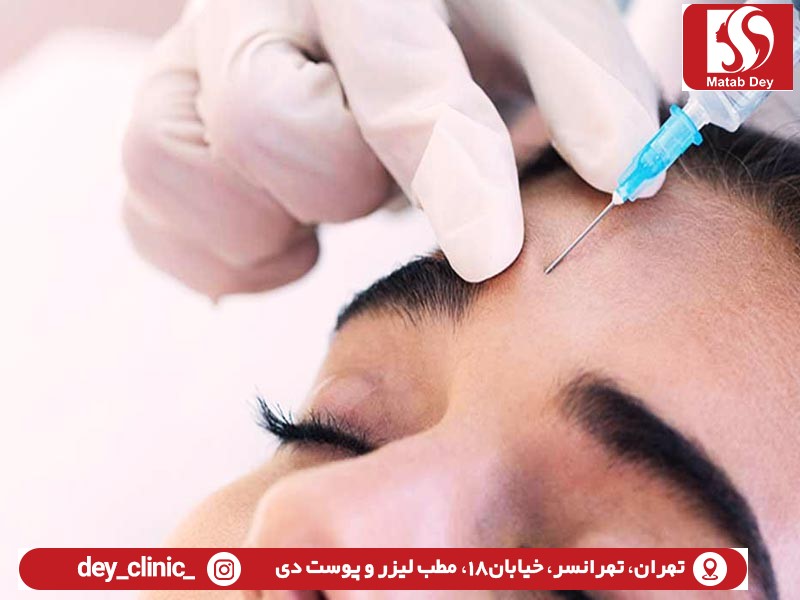 بوتاکی خط اخم | تزریق بوتا‌‌‌کس