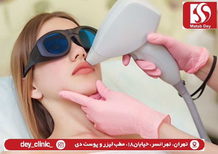 لیزر موهای زائد |لیزرموهای زائد در تهرانسر
