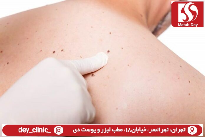 برداشتن خال با دستگاه fr تهرانسر