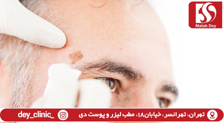 برداشتن خال با دستگاه rf |تهرانسر 